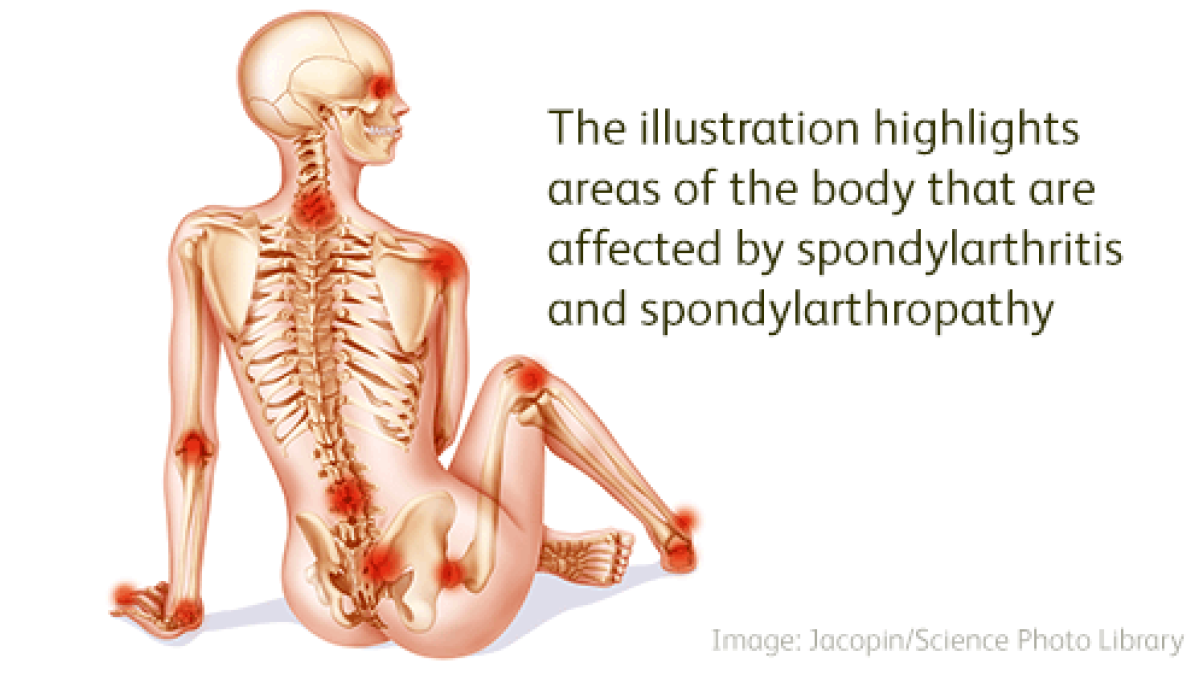 spondyloarthritis spondyloarthritis
