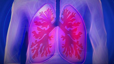 Illustration of lungs inflamed with COPD