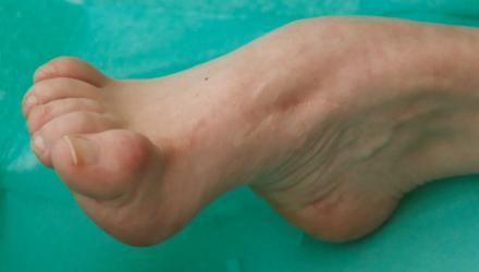 Charcot-Marie-Tooth disorder can cause changes in foot shape