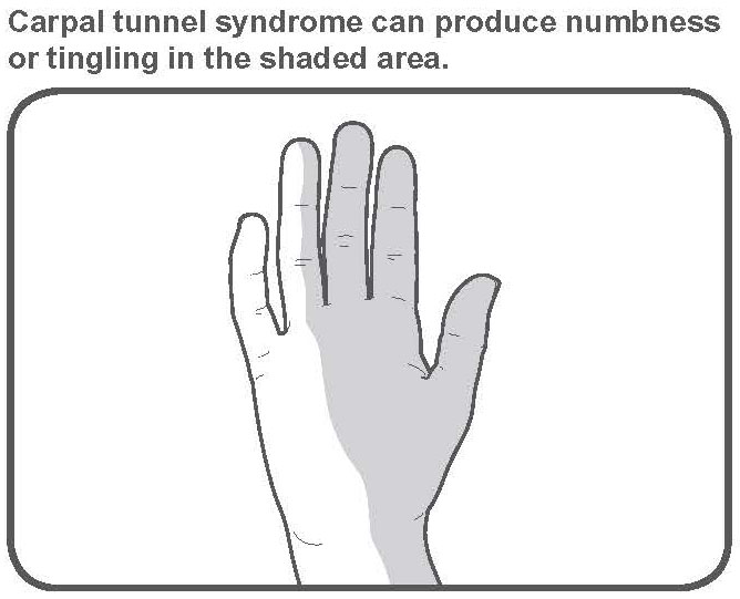Carpal Tunnel Syndrome | Facebook