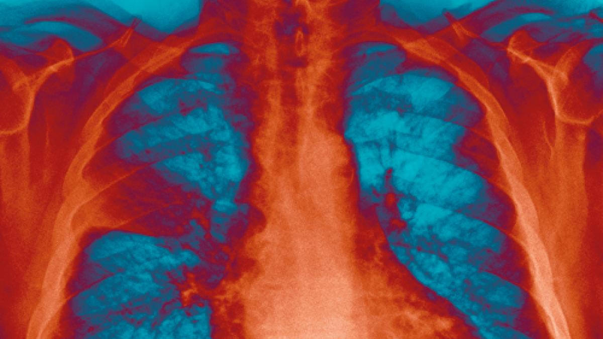 Physiotherapy and treating pneumonia