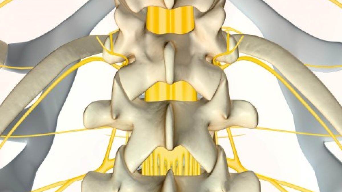 Clinical Update: Cauda equina syndrome Clinical Update: Cauda equina syndrome