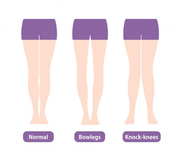 illustration of leg conditions