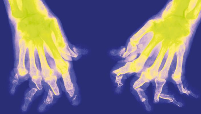 Physio findings: psoriatic arthritis linked to fracture risk