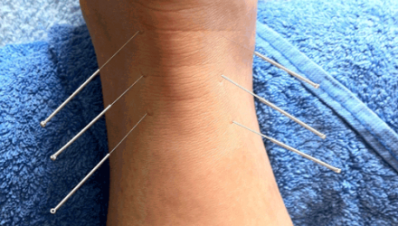 Acupuncture association offers insurance for fertility treatments
