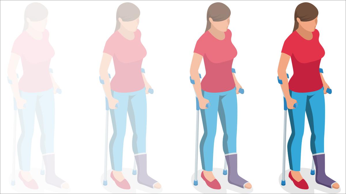 FL May 25 Research findings titled walking two weeks after ankle surgery is safe for many